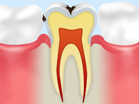C1 【エナメル質の虫歯】