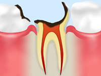 C3 【神経まで達した虫歯】