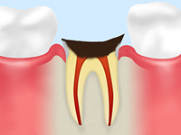 C4 【歯根まで達した虫歯】