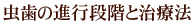 虫歯の進行段階と治療法